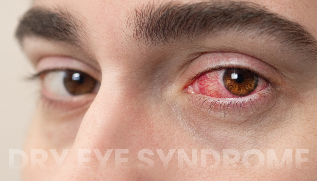 Dry-Eye-Syndrome